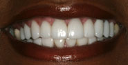 After Porcelain Dental Veneers by Austin Cosmetic Dentistry all Porcelain Bridge Porcelain Crowns Sedation Dentistry