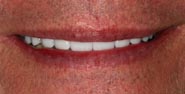 After Porcelain Dental Veneers Porcelain Crowns by Austin Cosmetic Dentistry Sedation Dentistry