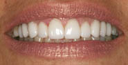 After Porcelain Dental Veneers by Austin Cosmetic Dentistry Gum Reduction