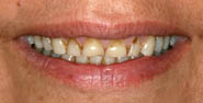 Austin Cosmetic Dentistry smile makeover before porcelain veneers