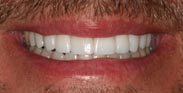 After Porcelain Dental Veneers by Austin Cosmetic Dentistry Smile Makeover