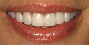 Porcelain Dental Veneers Porcelain Crowns Porcelain Bridge Gum Reduction Smile Makeover by Austin Cosmetic Dentistry