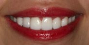 Porcelain Dental Veneers Porcelain Bridges Gum Reduction by Austin Cosmetic Dentistry
