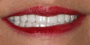 After Porcelain Dental Veneers by Austin Cosmetic Dentistry Gum Recontouring
