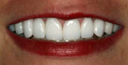 After Porcelain Dental Veneers by Austin Cosmetic Dentistry