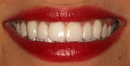 After Porcelain Dental Veneers by Austin Cosmetic Dentistry No Prep Porcelain Veneers Gum Recontouring