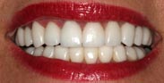 After Porcelain Dental Veneers by Austin Cosmetic Dentistry Gum Recontouring