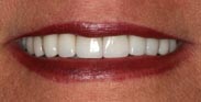 Porcelain Dental Veneers by Austin Cosmetic Dentistry Sedation Dentists