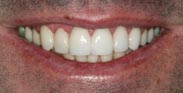 Porcelain Dental Veneers Smile Makeover by Austin Cosmetic Dentistry