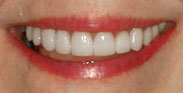 Porcelain Dental Veneers Porcelain Crowns Gum Reduction Smile Makeover by The Cosmetic Dentist of Austin