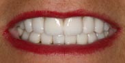 Porcelain Dental Veneers Porcelain Crowns Gum Reduction 2 Visit Smile Makeover by Austin Cosmetic Dentistry