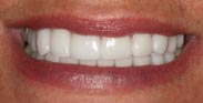 Porcelain Dental Veneers Porcelain Crowns Gum Reduction Smile Makeover by Austin Cosmetic Dentistry