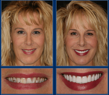 An Austin Cosmetic Dentist Can Get You Ready For Spring With a Smile Makeover! Call today to schedule a Complimentary Consultation at 512.333.7777.