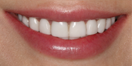 thecosmeticdentistsofaustin-Cassie-smile-After