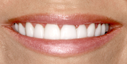 thecosmeticdentistsofaustin-anna-smile-after