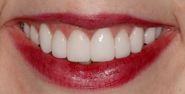 thecosmeticdentistsofaustin-emily-smile-after