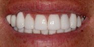 thecosmeticdentistsofaustin-james-smile-after