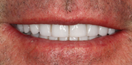 thecosmeticdentistsofaustin-jason-smile-after