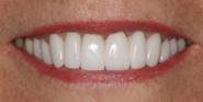 thecosmeticdentistsofaustin-joy-smile-after