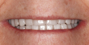 thecosmeticdentistsofaustin-karen-smile-after