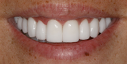 thecosmeticdentistsofaustin-laura-smile-after