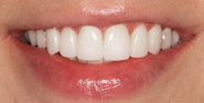thecosmeticdentistsofaustin-layla-smile-after