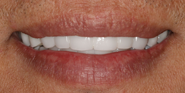 thecosmeticdentistsofaustin-mike-smile-after