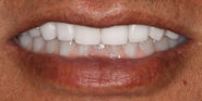 thecosmeticdentistsofaustin-moses-smile-after