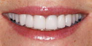 thecosmeticdentistsofaustin-sarah-smile-after