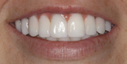 thecosmeticdentistsofaustin-sarah2-smile-after