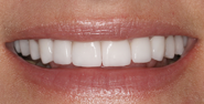 thecosmeticdentistsofaustin-terri-smile-after