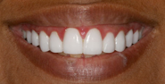 thecosmeticdentistsofaustin-ayushi-smile-after