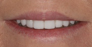 thecosmeticdentistsofaustin-brenda-smile-after