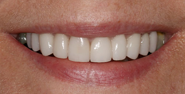 thecosmeticdentistsofaustin-diane-smile-after