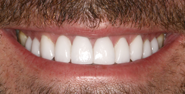 thecosmeticdentistsofaustin-fran-smile-after