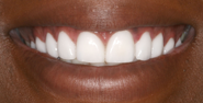 thecosmeticdentistsofaustin-rama-smile-after