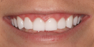 thecosmeticdentistsofaustin-victoria-smile-after