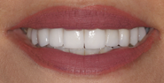 thecosmeticdentistsofaustin-zainab-smile-after