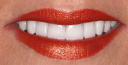 thecosmeticdentistsofaustin-Hannah-smile-after