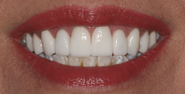 thecosmeticdentistsofaustin-Amie-smile-after