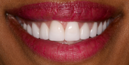 thecosmeticdentistsofaustin-Carolyn-smile-after