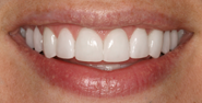 thecosmeticdentistsofaustin-Heather-smile-after
