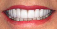 thecosmeticdentistsofaustin-Holly-smile-after