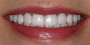 thecosmeticdentistsofaustin-Melinda-smile-after