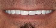 thecosmeticdentistsofaustin-Normand-smile-after