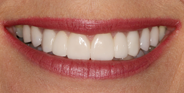 thecosmeticdentistsofaustin-Trina-smile-after