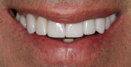 thecosmeticdentistsofaustin-Cristin-smile-after