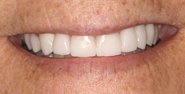 thecosmeticdentistsofaustin-Ruby-smile-after