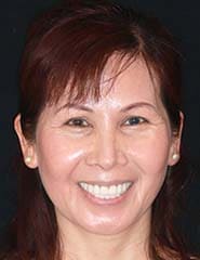 Reconstructive Dentistry | Patient Case-Huong