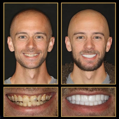 before and after veneers
